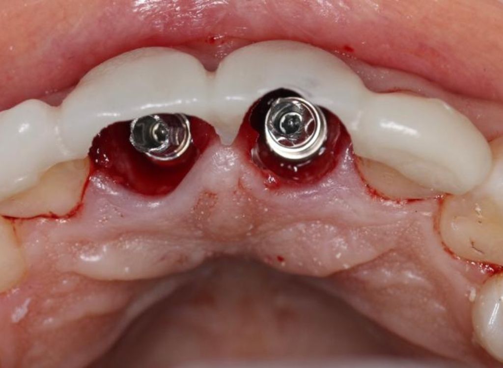 Cirugia e implantes 1