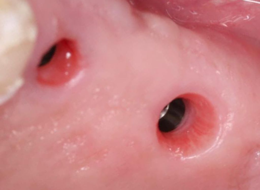 Cirugia e implantes 2