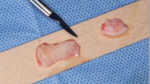 Paso a paso de un injerto de tejido conectivo asociado a un implante