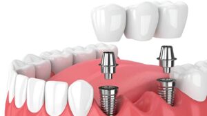 Prótesis fija con carga inmediata