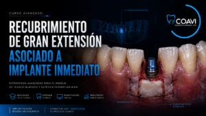 Recubrimiento de gran extensión asociado a implante inmediato