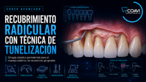 Recubrimiento radicular con técnica de tunelización